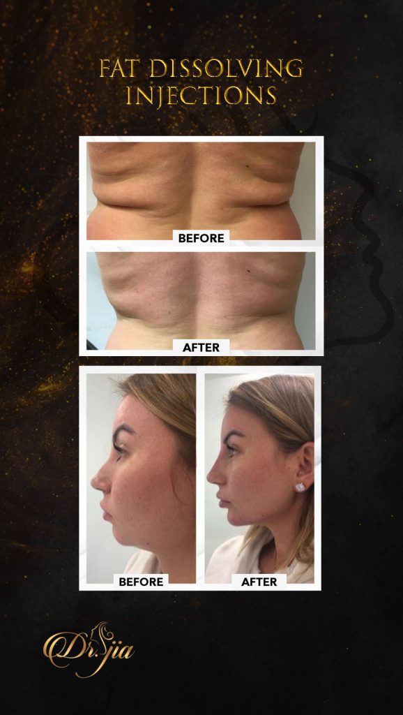Fat Dissolving Inj - Best Dermatologist in UAE