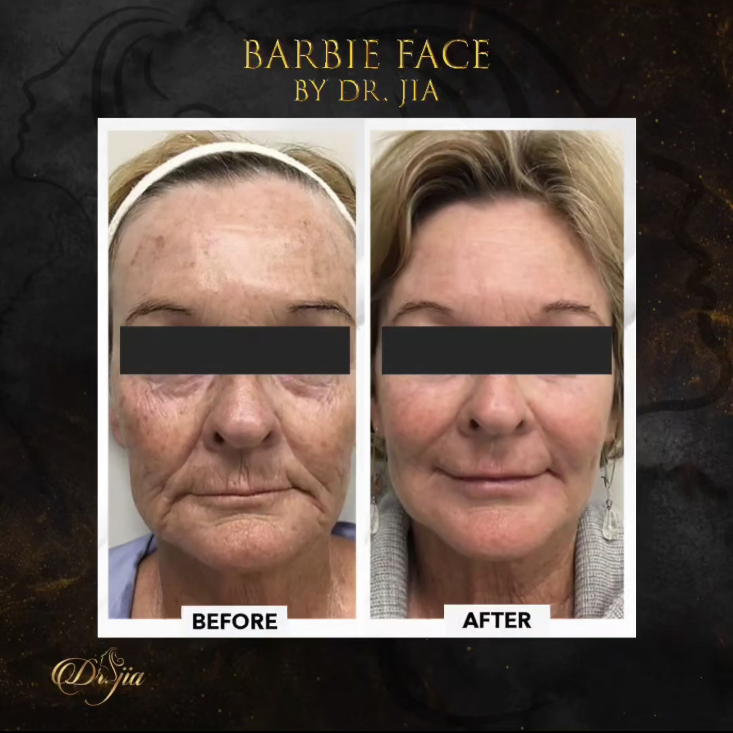 Best Dermatologist in Dubai - Barbie Face Treatment - best dermatologist