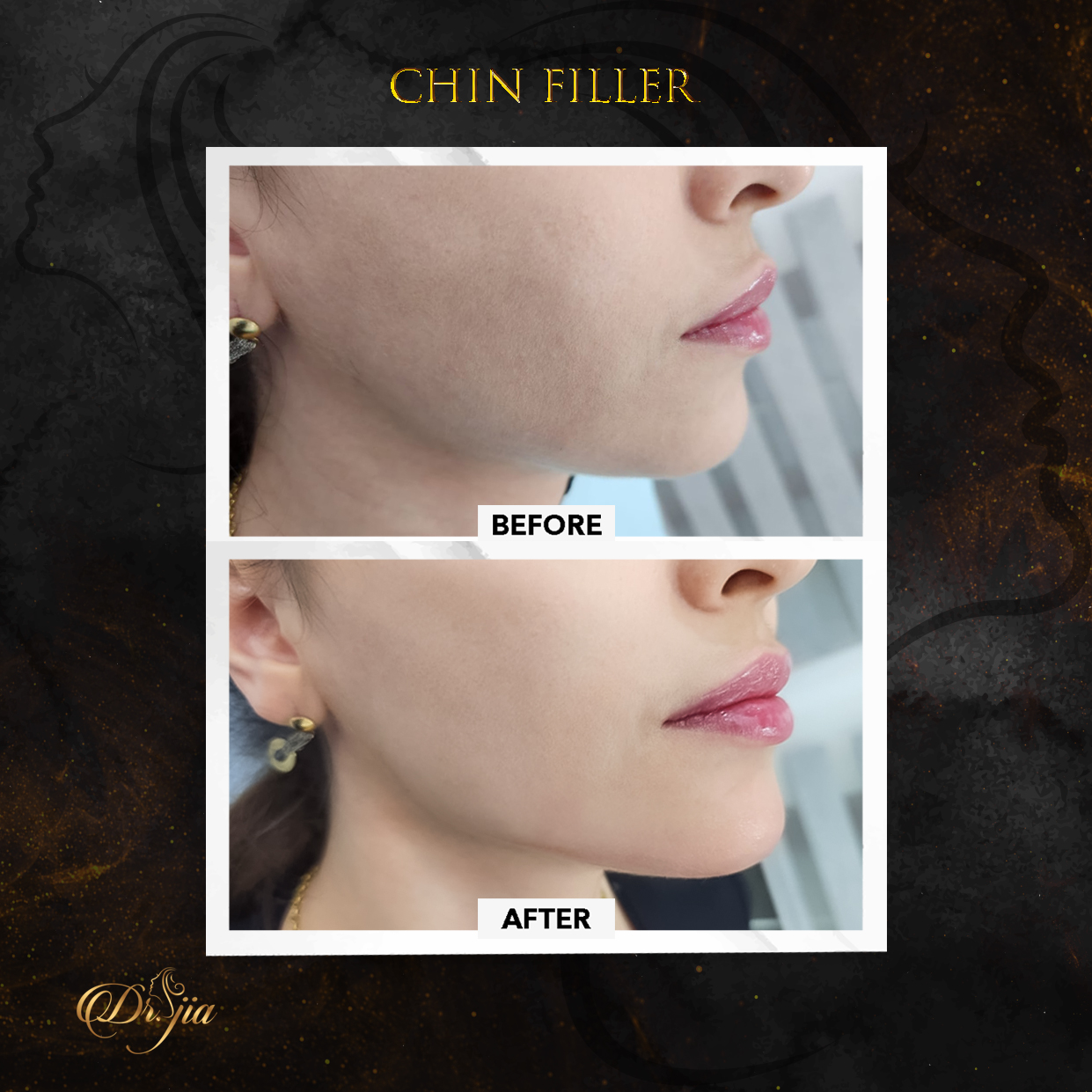 Best Dermatologist in Dubai - best dermatologist - Beautifictional By Dr Jia - Chin filler