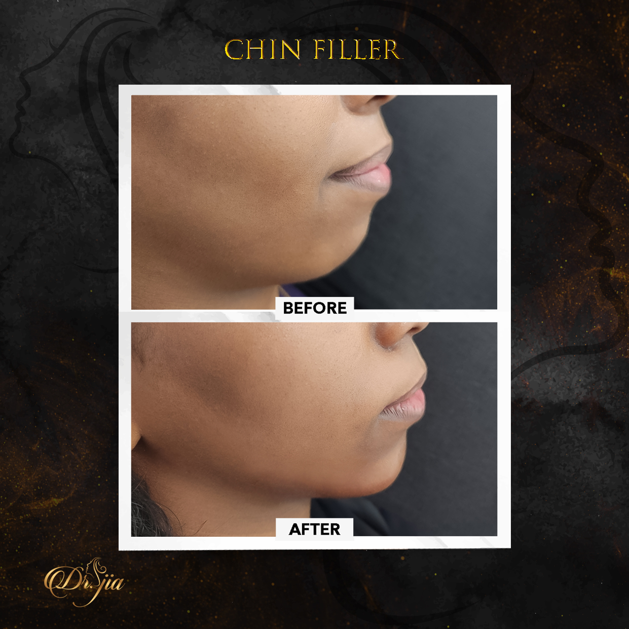 Best Dermatologist in Dubai - best dermatologist - Acne Treatment - Chin Filler