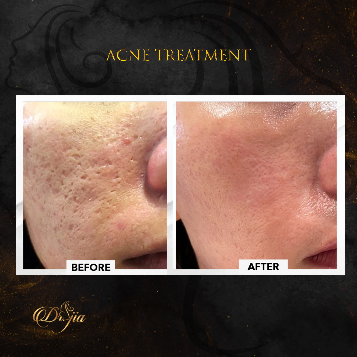 Best Dermatologist in Dubai - best dermatologist - Acne Treatment
