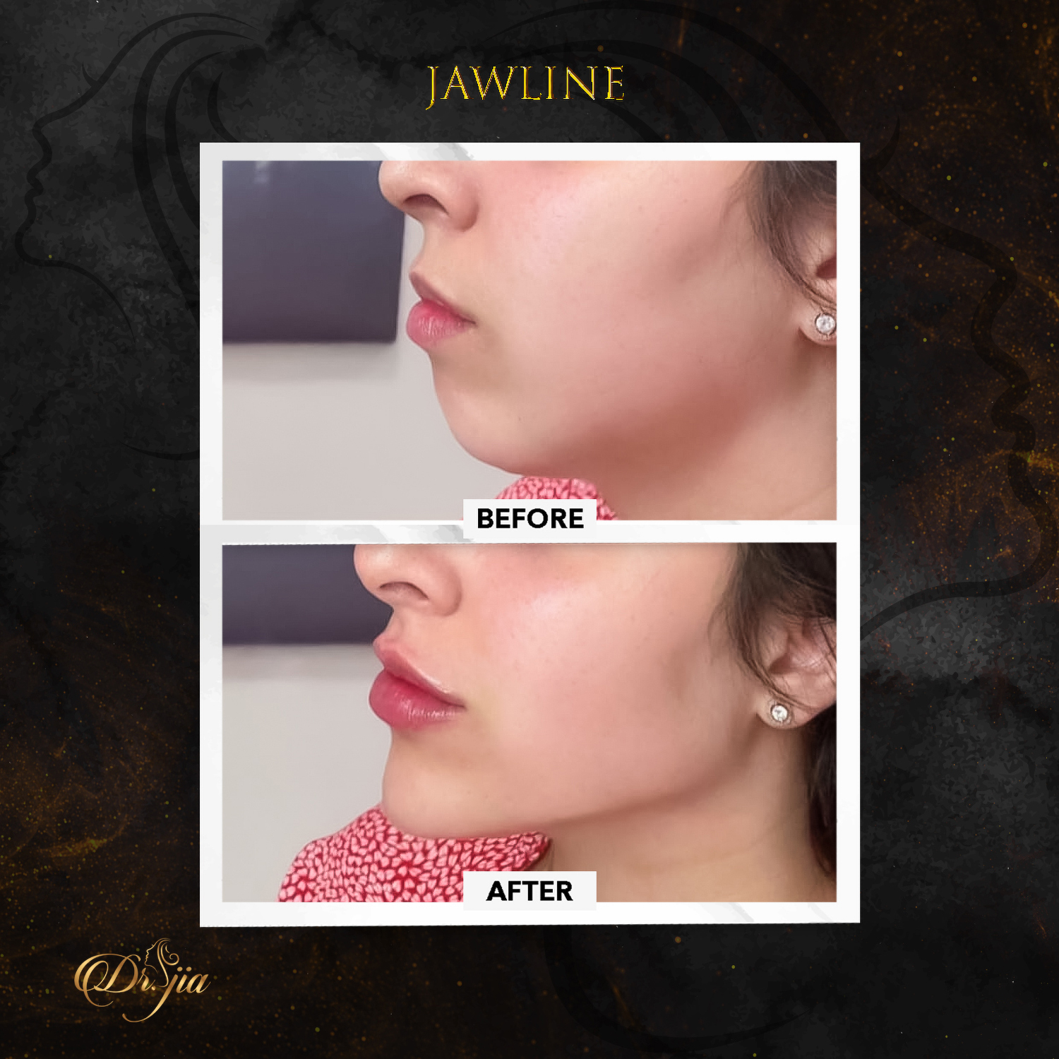 Best Dermatologist in Dubai - Acne Treatment - best dermatologist