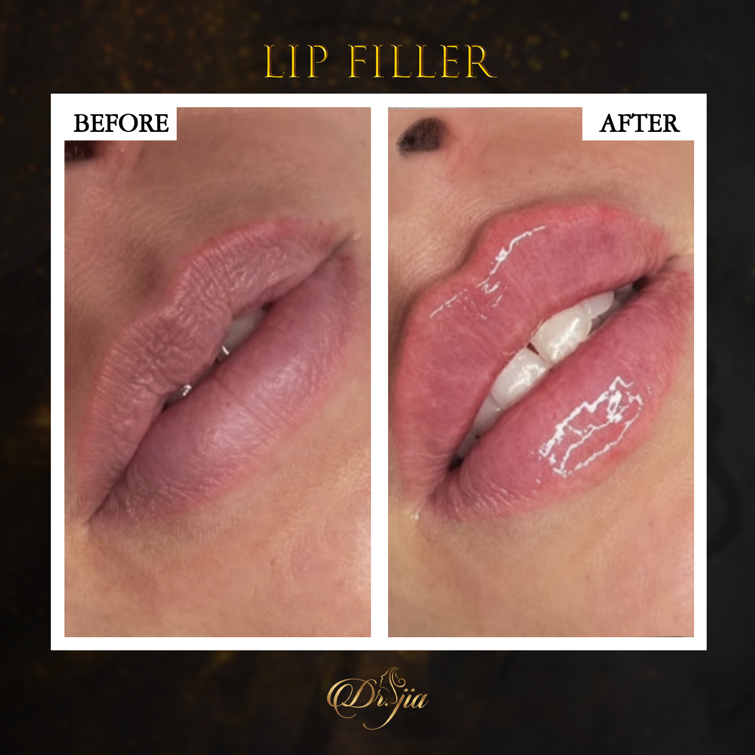 Best Dermatologist in Dubai - Lip Filler - Skin Specialist in Abu Dhabi