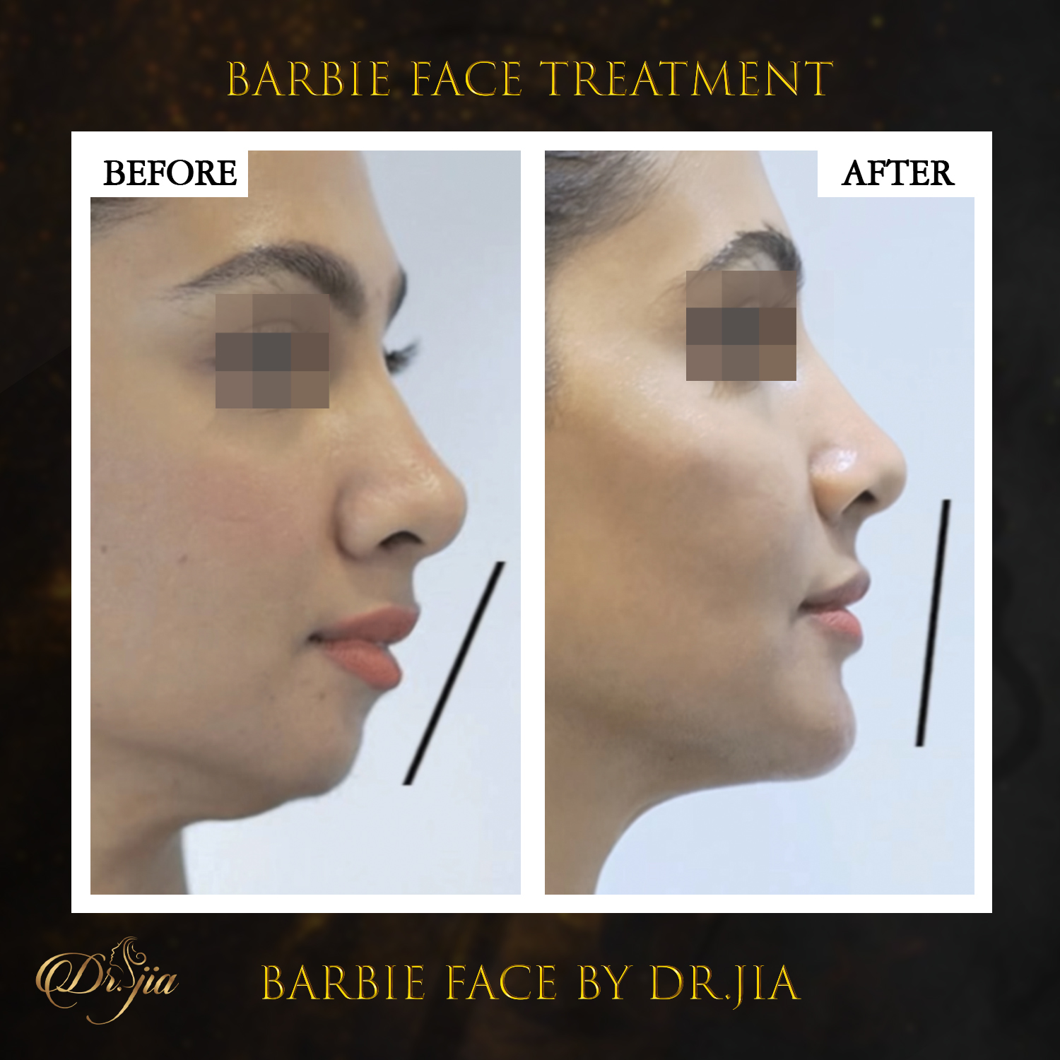 Best Dermatologist in Dubai - Barbie Face Treatment - best dermatologist