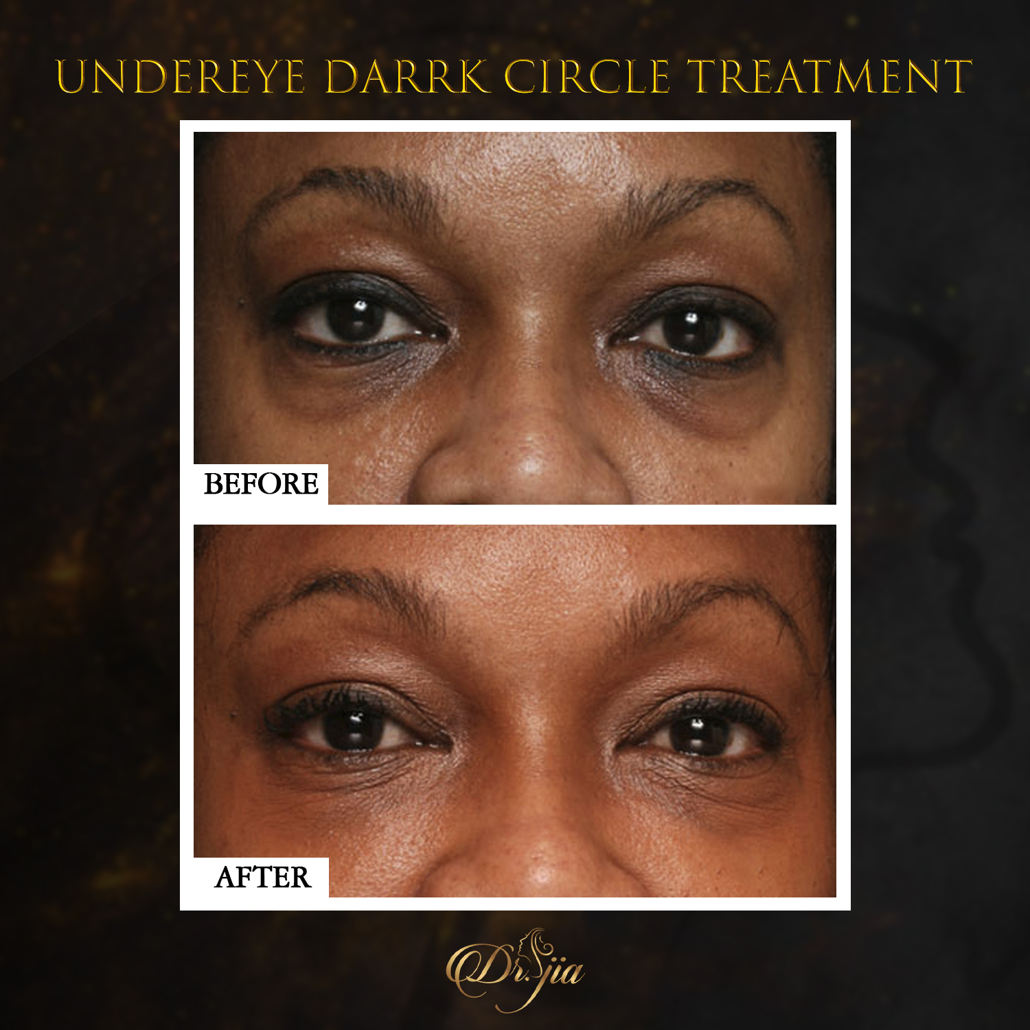 Dark circle Reduction - Best Dermatologist in Dubai