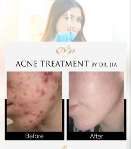 Best Dermatologist in Dubai UAE Treat Acne Scars Best Dermatologist in Dubai UAE Treat Acne Scars - Best Dermatologist in UAE - Best Skin Specialist in Dubai