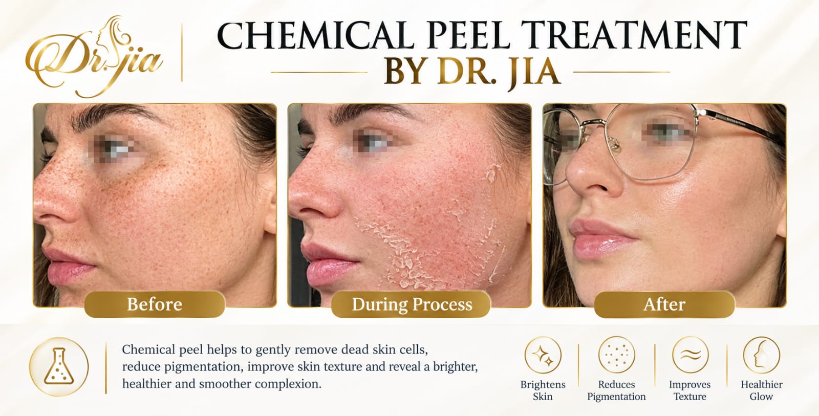 Chemical Peel Treatment in UAE | Dr. Javeria Jia – Skin Treatments Dubai